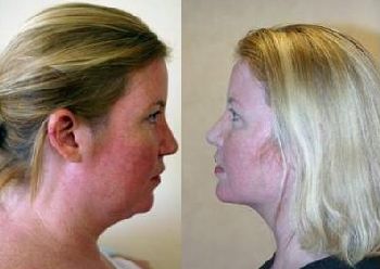 This woman is shown before, and one week after surgery