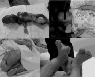 Fallujah birth defects