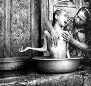 Thi Hoi bathes her 14-year-old son, Bui Quang Ky. She was exposed to Agent Orange when she was in the North Vietnamese Army during the war